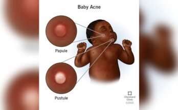 Baby Acne Care Tips