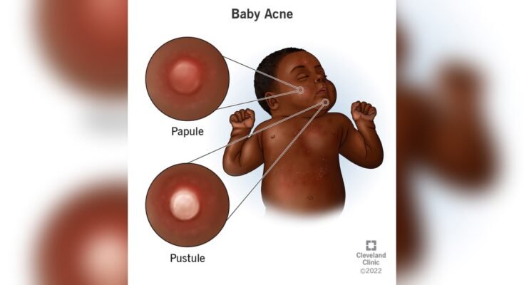 Baby Acne Care Tips