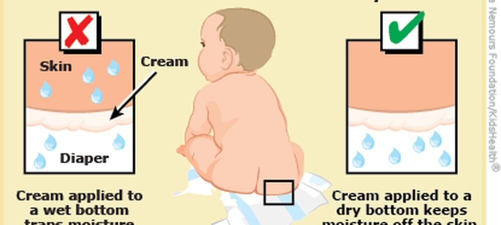 Baby Rash Treatment