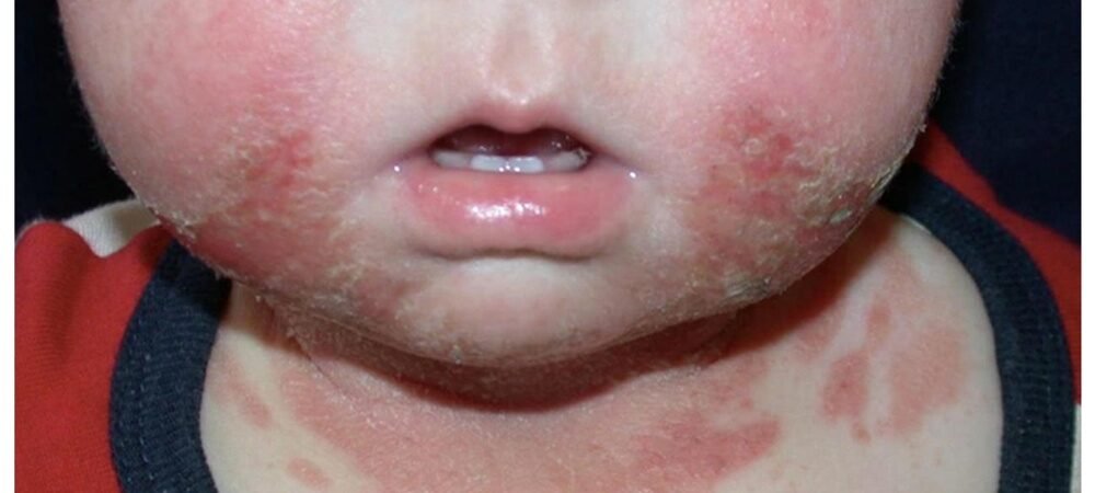 Baby Skin Rashes Causes