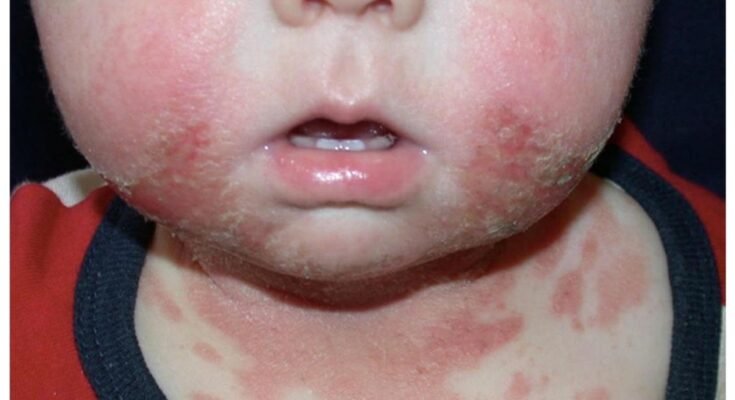 Baby Skin Rashes Causes