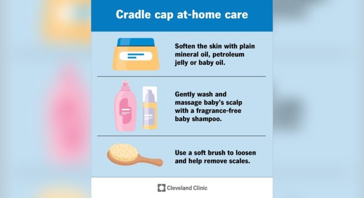 Cradle Cap Management