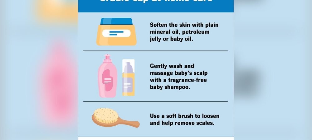 Cradle Cap Treatment