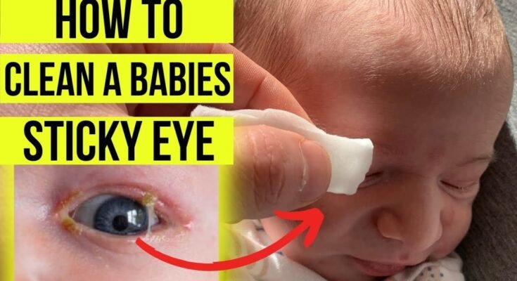 Eye Discharge in Newborn