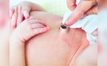 How to Care for Baby’S Umbilical Cord