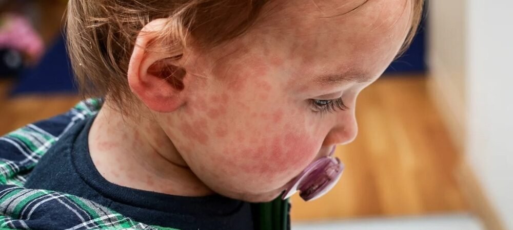 Identifying Food Allergies in Newborn