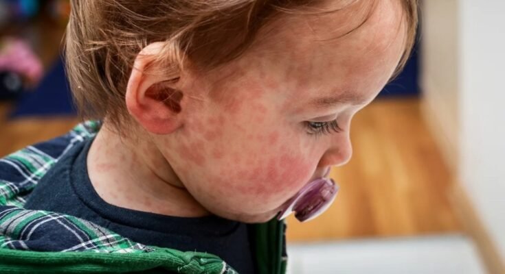 Identifying Food Allergies in Newborn