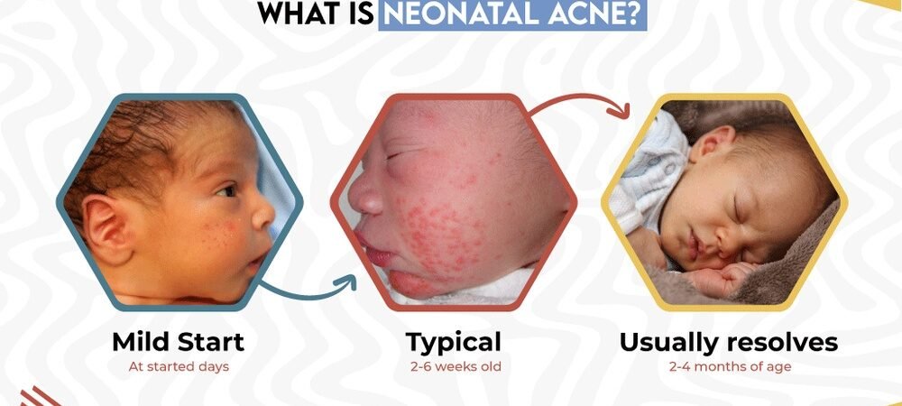 Newborn Acne Care