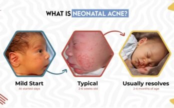 Newborn Acne Care
