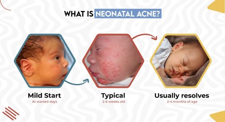 Newborn Acne Care