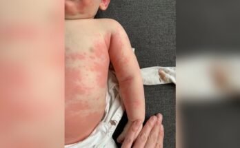 Newborn Allergic Reactions