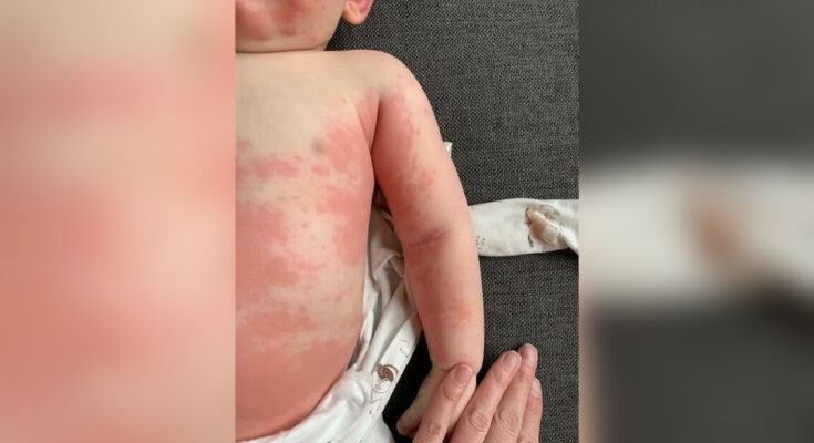 Newborn Allergic Reactions
