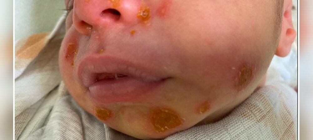 Newborn Skin Infections