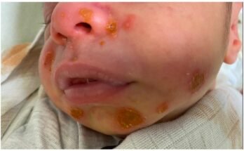 Newborn Skin Infections