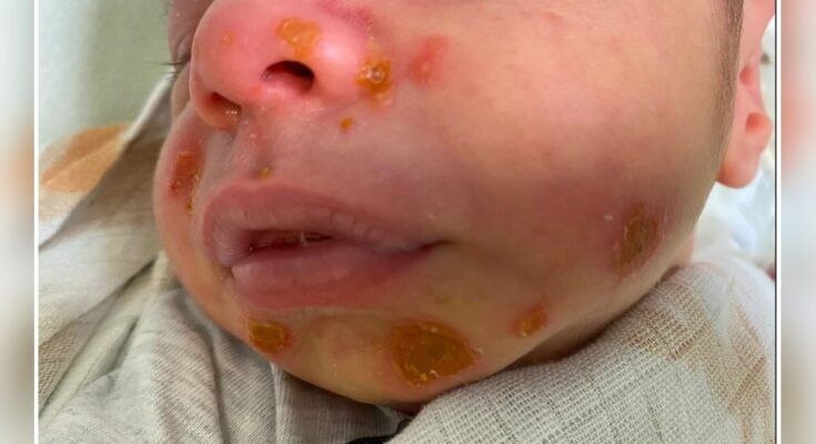 Newborn Skin Infections