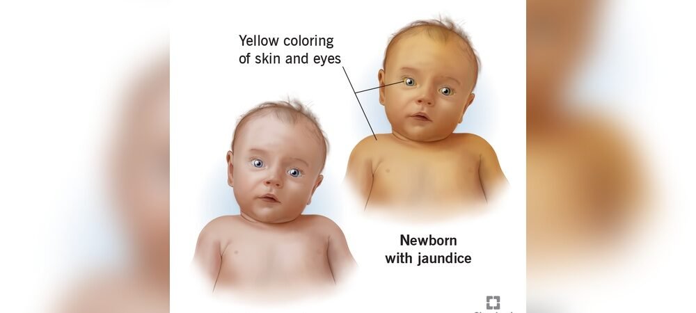 Yellow Skin in Newborn
