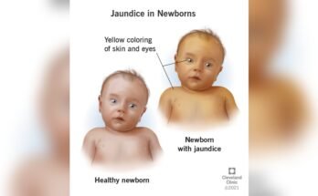 Yellow Skin in Newborn