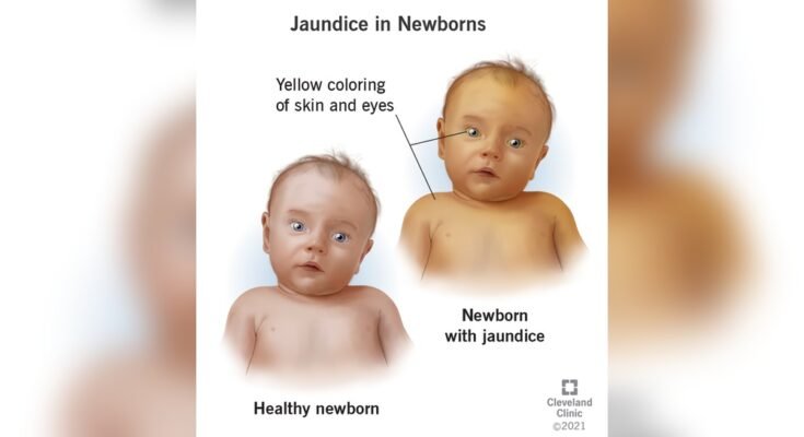 Yellow Skin in Newborn